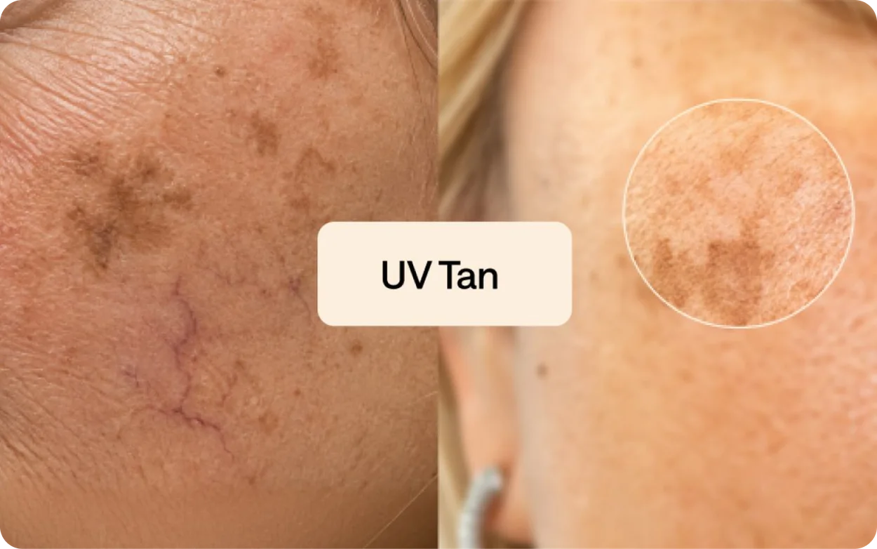 UV tan: sun-damaged skin with uneven dark spots, compared with an even complexion